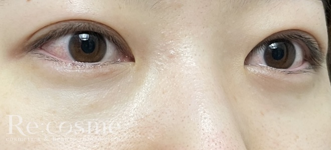 ヒアロディープパッチを目元に貼った様子